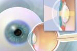Chủ đề tháng 9 số 1: Phát hiện, phòng ngừa, điều trị một số bệnh lý về mắt do lão hóa