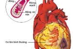 Xơ vữa động mạch: Nguyên nhân chính gây đột quỵ