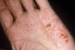 GLTT tháng 3 “Bệnh eczema: Giải pháp phòng ngừa và điều trị toàn diện”
