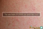 Tại sao bệnh ECZEMA lại tái phát liên tục?