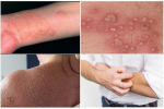 Điều trị bệnh chàm eczema bằng dầu dừa nguyên chất có tác dụng gì?