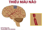 Giải đáp thắc mắc: Người bị thiếu máu não uống nước gì để cải thiện?