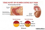 Nguyên nhân và biện pháp phòng tránh suy thận