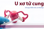 Những biến chứng của u xơ tử cung nguy hiểm như thế nào? Xem ngay!