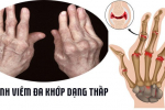 Viêm đa khớp dạng thấp kiêng ăn gì để bệnh không tiến triển năng?