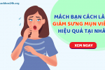 Mách bạn 4 cách giảm sưng mụn viêm cho hiệu quả cực nhanh. XEM NGAY!