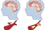Các bước chẩn đoán tai biến mạch máu não và cách điều trị - XEM NGAY!