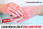 6 quan niệm sai lầm về bệnh chàm phổ biến. Liệu bạn có biết? 