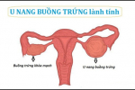 U nang buồng trứng lành tính và cách điều trị an toàn, hiệu quả