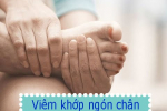 Bệnh viêm khớp ngón chân và những thông tin cần biết