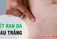 Những vết rạn da màu trắng tràn lan trên cơ thể? - Áp dụng ngay cách này!