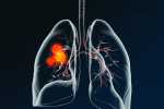 Cách điều trị ung thư phổi thứ phát và giải pháp hỗ trợ từ sản phẩm thảo dược. ĐỌC NGAY