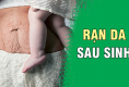 Cách trị rạn da sau sinh tại nhà an toàn, đơn giản – Mẹ bỉm sữa nhớ ghi!