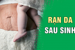 Cách trị rạn da sau sinh tại nhà an toàn, đơn giản – Mẹ bỉm sữa nhớ ghi!