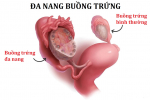 Đa nang buồng trứng kiêng ăn gì? - Top 5 thực phẩm cần tránh