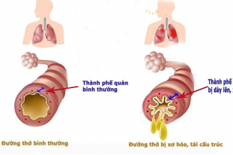 Đi tìm lời giải đáp cho câu hỏi: VIÊM PHẾ QUẢN CẤP CÓ LÂY KHÔNG?