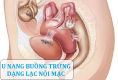 U nang buồng trứng dạng lạc nội mạc tử cung và cách điều trị hiệu quả