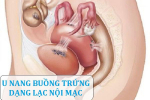 U nang buồng trứng dạng lạc nội mạc tử cung và cách điều trị hiệu quả