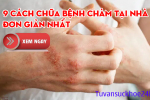 9 cách chữa bệnh chàm tại nhà đơn giản nhất. Không thể bỏ lỡ!