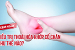 Điều trị thoái hóa khớp cổ chân như thế nào? Câu trả lời có ngay TẠI ĐÂY!