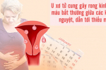 Tại sao u xơ tử cung gây rong kinh? Xem ngay!