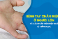 Bệnh tay chân miệng ở người lớn và cách cải thiện hiệu quả từ thảo dược