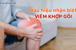 Dấu hiệu viêm khớp gối và cách cải thiện hiệu quả từ thảo dược.