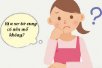 Bị u xơ tử cung có nên mổ không? Xem ngay để biết tường tận!