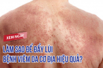 Làm sao để đẩy lùi bệnh viêm da cơ địa hiệu quả? CLICK NGAY!