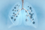 Ung thư phổi không phải tế bào nhỏ - Nguyên nhân, triệu chứng và giải pháp cải thiện từ thảo dược. ĐỌC NGAY!