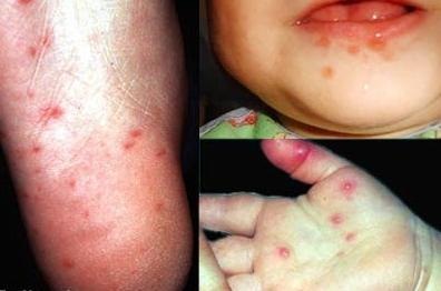 Bệnh ngoài da do virus
