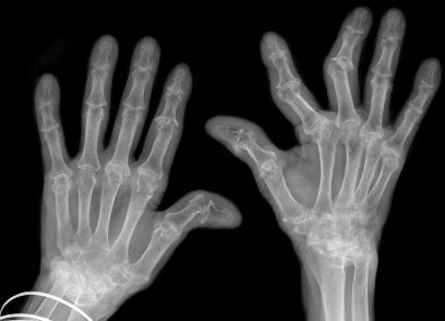 Hình ảnh bàn tay của người bị viêm khớp dạng thấp