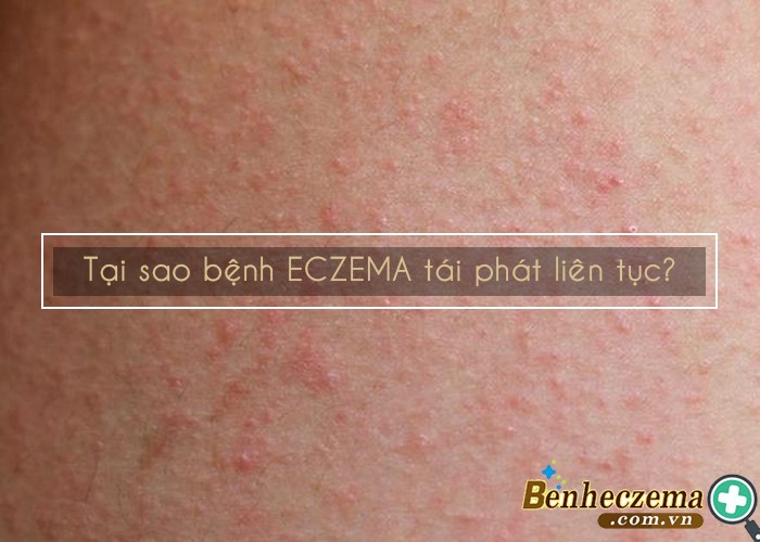 Bệnh eczema rất hay tái phát