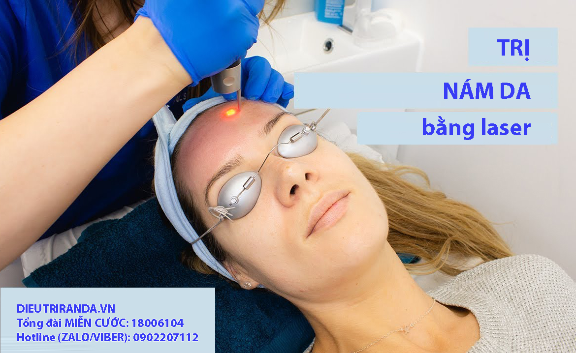 Trị nám da bằng laser cho hiệu quả nhanh nhưng khó bền