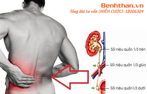 Vị trí sỏi niệu quản 1/3 dưới