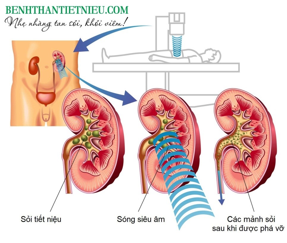 Tán sỏi bằng sóng xung kích là phẫu thuật điều trị sỏi tiết niệu phổ biến nhất