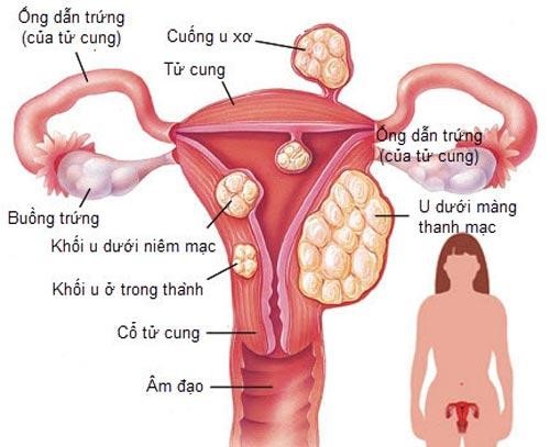    U xơ tử cung là bệnh lý phổ biến ở phụ nữ