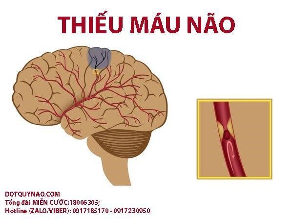    Thiếu máu não có thể dẫn đến đột quỵ vô cùng nguy hiểm