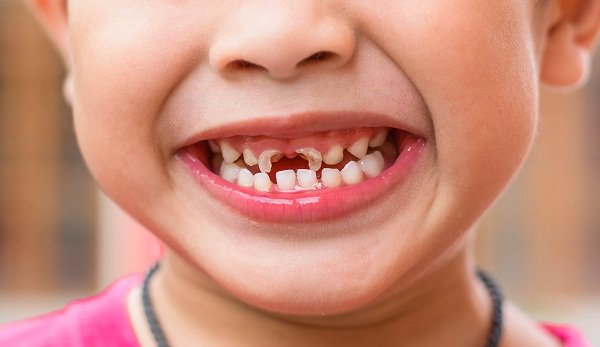    Vì sao trẻ bị sâu răng