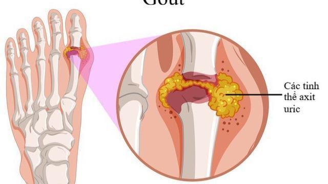 Bệnh gout hình thành do tinh thể acid uric lắng đọng tại khớp