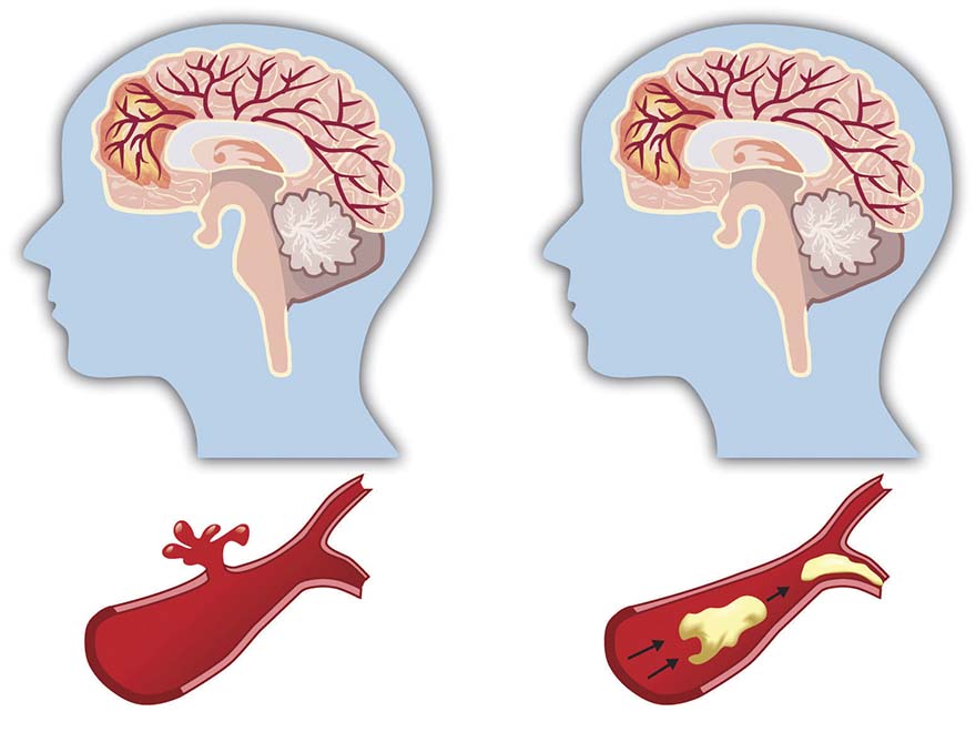 Tai biến mạch máu não xảy ra do quá trình cung cấp máu đến não bị gián đoạn