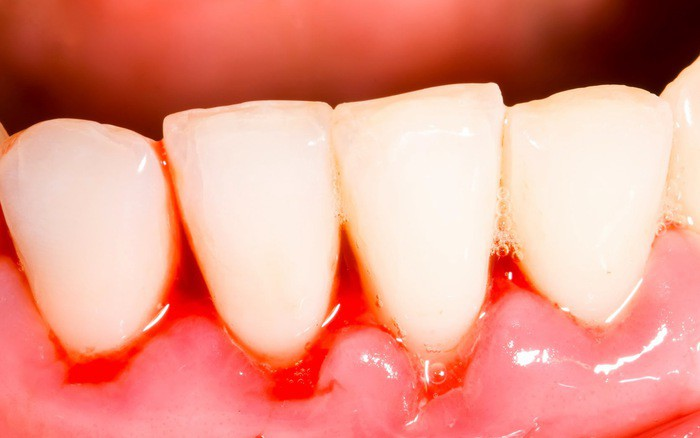  Bệnh viêm nướu có thể gây chảy máu chân răng