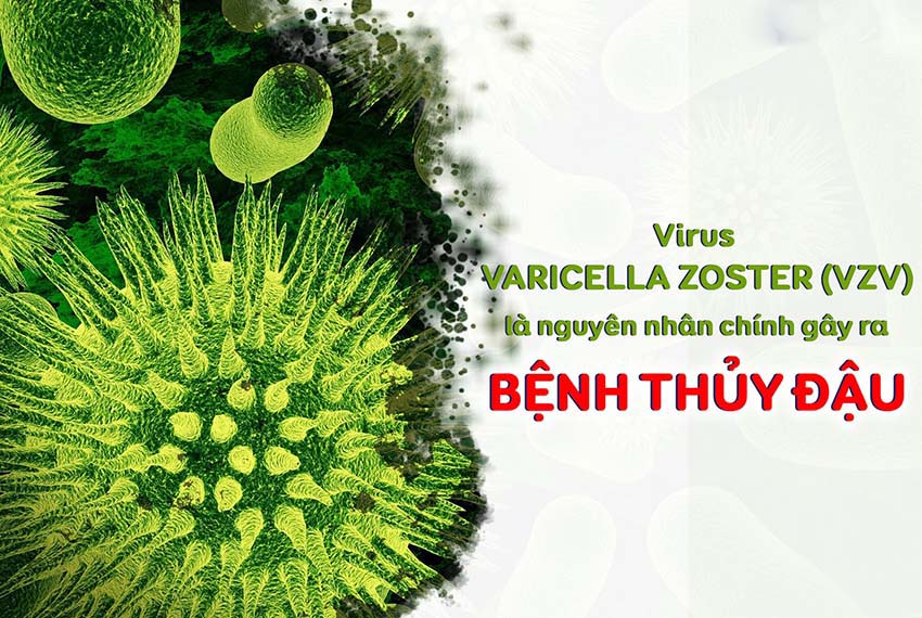 Virus Varicella - Zoster là nguyên nhân gây bệnh thủy đậu