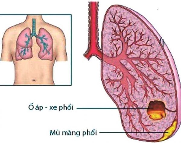 Viêm phổi có thể gây ra tình trạng áp xe phổi