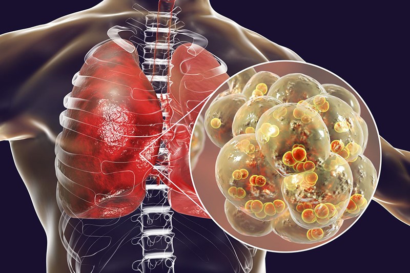   Viêm phổi là tình trạng nhiễm trùng nhu mô phổi