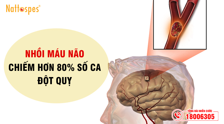 Nhồi máu não chiếm 80% số ca đột quỵ