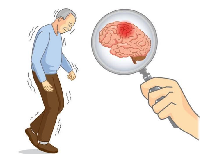 Nhồi máu não có rất nhiều triệu chứng tổn thương thần kinh