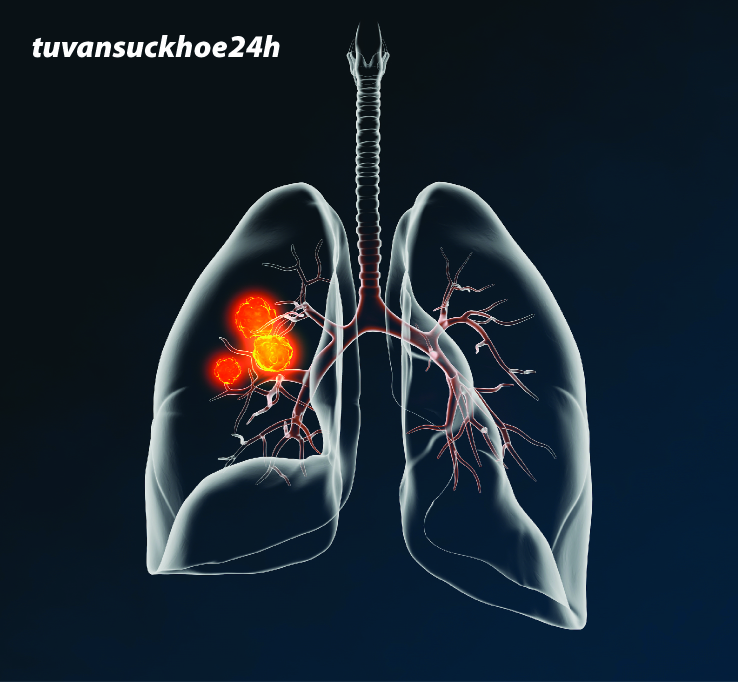 Ung thư phổi thứ phát là tình trạng nguy hiểm cần điều trị kịp thời