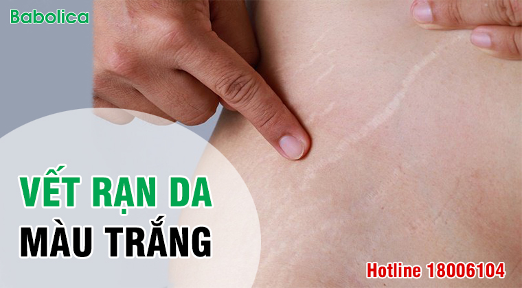 Vết rạn da màu trắng xuất hiện do tổn thương da từ lâu