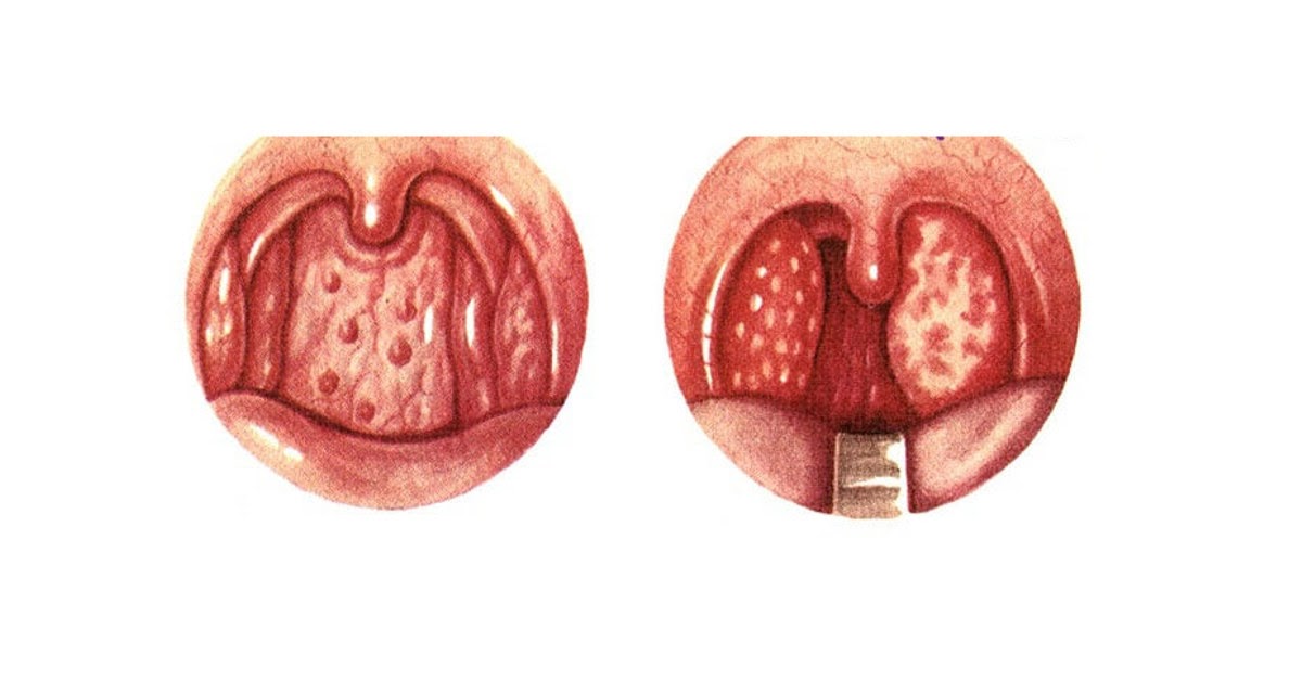 Viêm họng hạt là bệnh đường hô hấp trên phổ biến